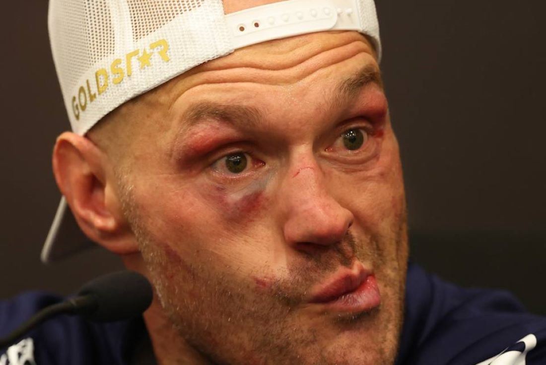 Tyson Fury.