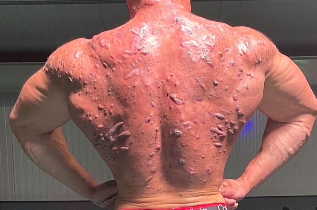 Steroidy jsou problém...