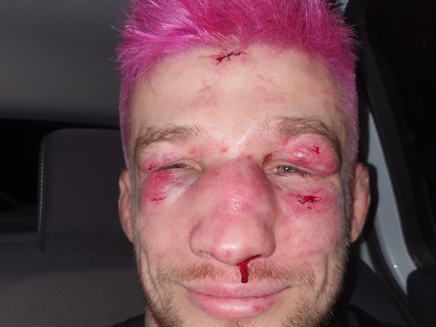 Zápasník MMA David Kozma pár hodin po zápase.