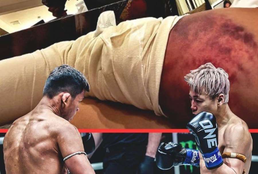 Hororové následky titulové bitvy. Japonec ukázal napuchlou nohu s utrženým svalem