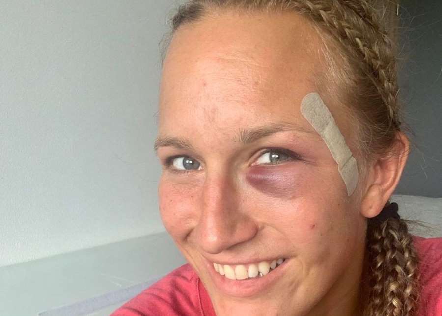 Ani monokl nezabrání velkému podpisu. Česká MMA zápasnice bude bojovat v USA. Dojde na milion dolarů?