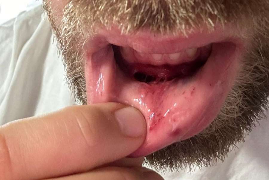 Rána pěstí a neobvyklé zranění vyřadilo boxera ze zápasu v Brně